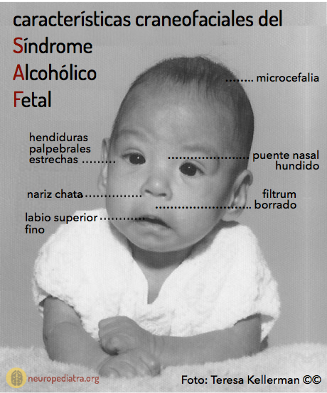 S ndrome Alcoh lico Fetal Neuronas En Crecimiento S ndrome Alcoh lico Fetal Neuronas En Crecimiento