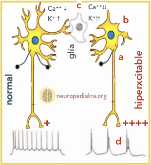 epilepsia